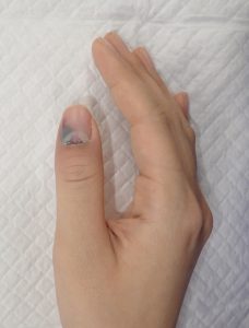 突き指 と 骨折 の 違い